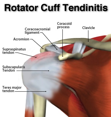 Rotator Cuff Injuries Impingement Syndrome Vasta Performance Training And Physical Therapy