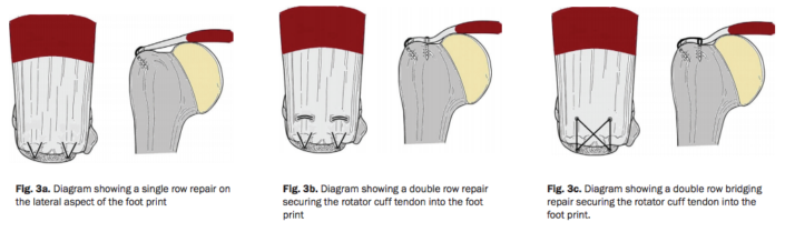 Rotator Cuff Injuries Impingement Syndrome Vasta Performance