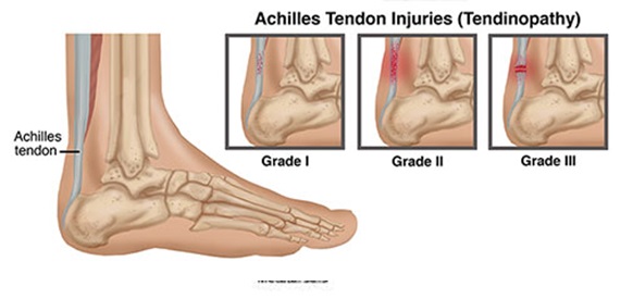 Achilles Tendonitis - VASTA Performance Training and Physical Therapy