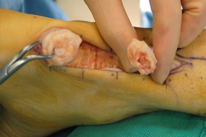 This image shows an open ‘repair' of an achilles tendon. Note the central degenerated section within the tendon
