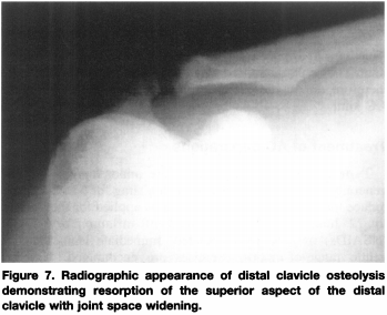X-ray AC Joint
