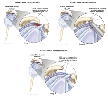 Rotator Cuff Injuries / Impingement Syndrome - Vasta Performance ...