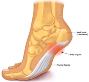 Plantar Fasciitis - Vasta Performance Training and Physical Therapy