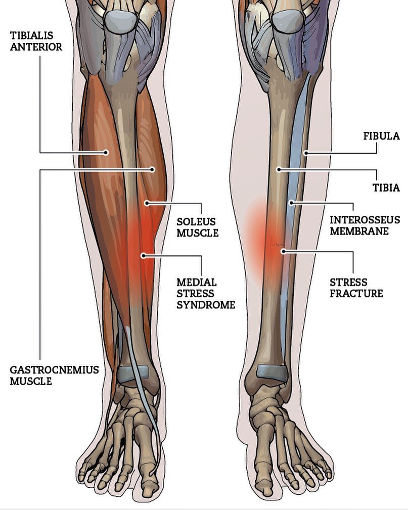 help with shin pain after tib fib fracture