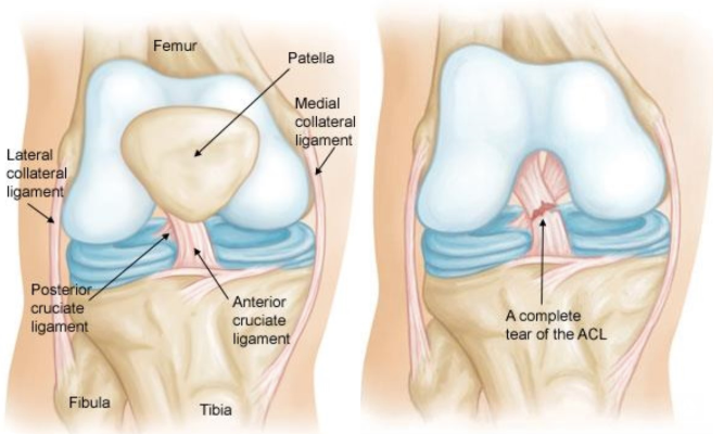 ACL Injury) Anterior Cruciate Ligament Tear Symptoms & Surgery