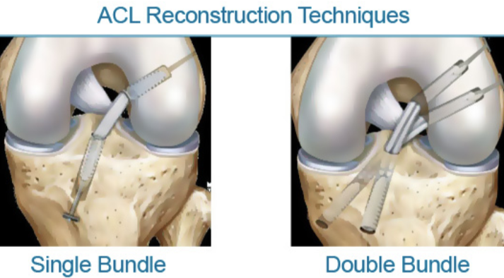 Physical Therapy in California South Bay for ACL Patellar Tendon Graft  Reconstru