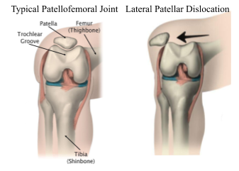 Kneecap Instability  Medial vs Lateral Patellar Dislocation