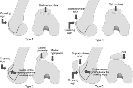 Patellar Instability - Vasta Performance Training and Physical Therapy